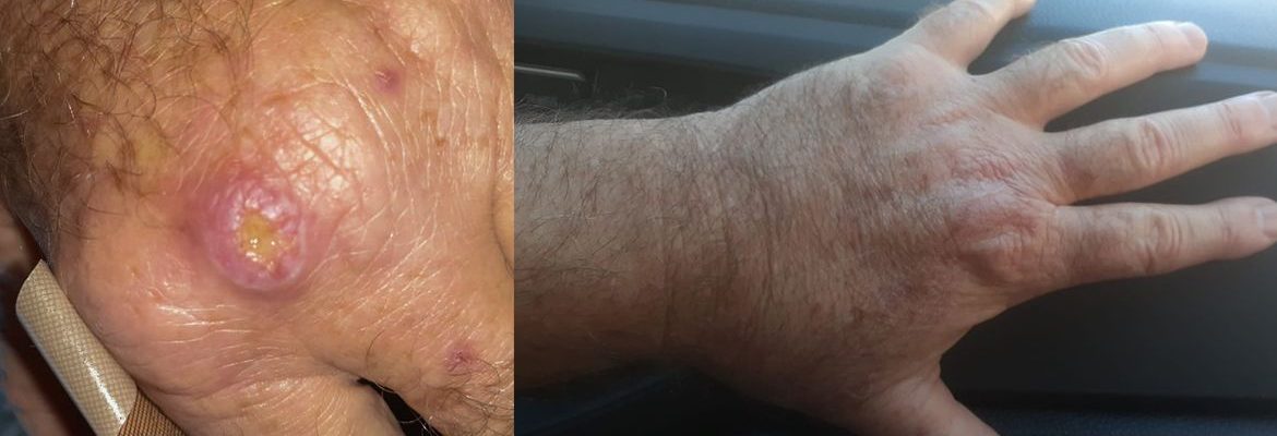 Especialistas alertam para a falta de informação sobre a leishmaniose